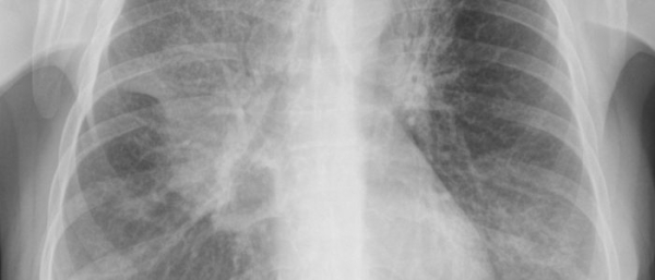 Липома легких