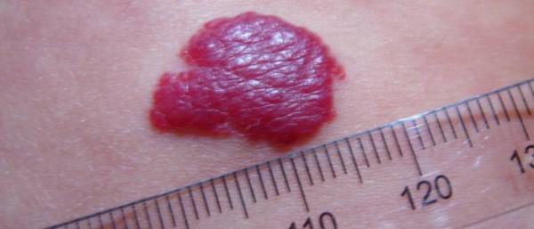 Гемангиома у взрослого