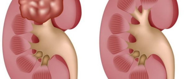 Липома в почке