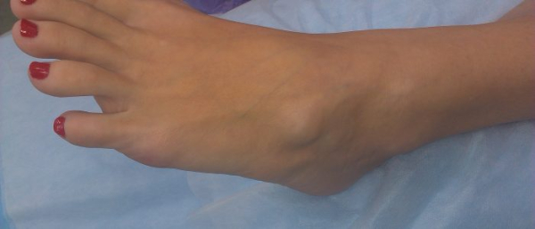 Хирургическое лечение гигромы