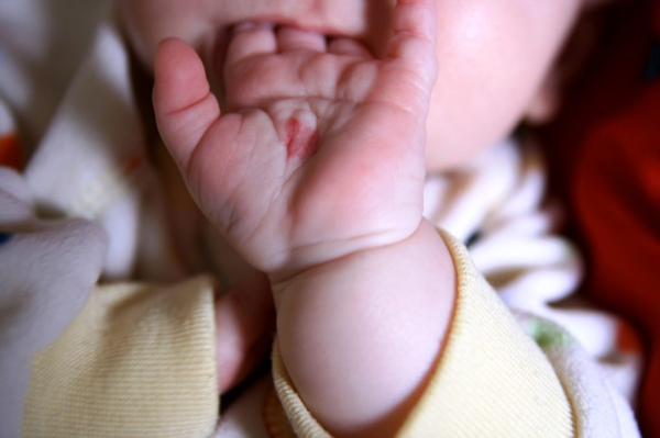 Гемангиома у ребенка