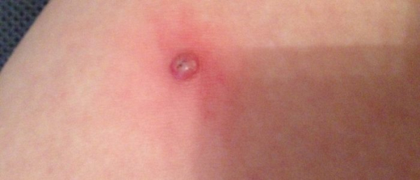 Как заживает папиллома и бородавка после удаления?