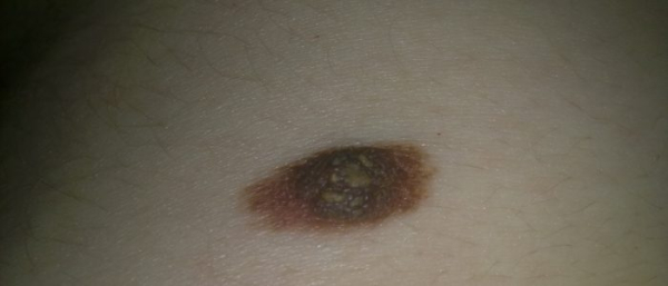 Висячие родинки в подмышках