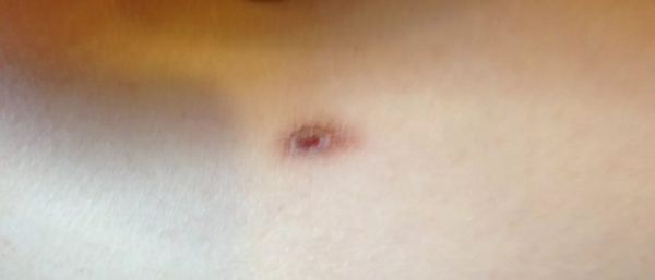 Как бриться с родинкой?