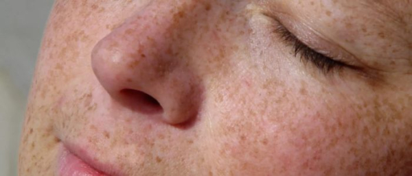 Пилинг от гиперпигментации