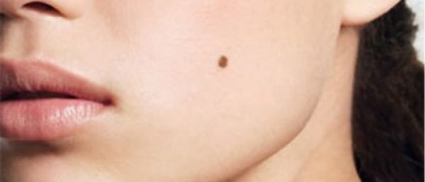 Родинки на щеках у мужчин и женщин