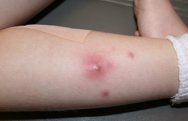 Воспаление и боль в жировике