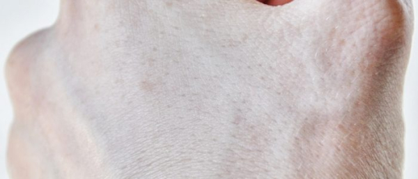 Vichy и пигментные пятна