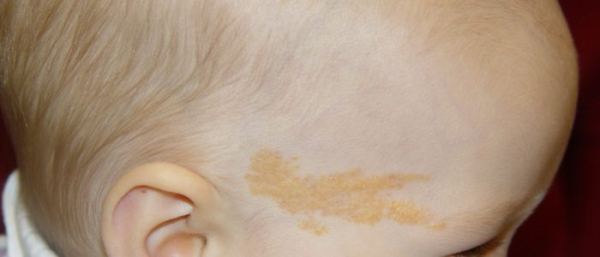 Невус ядассона