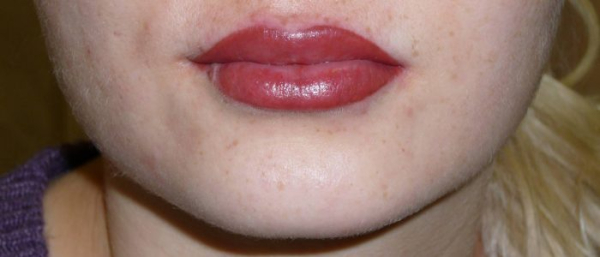Родинки на губе