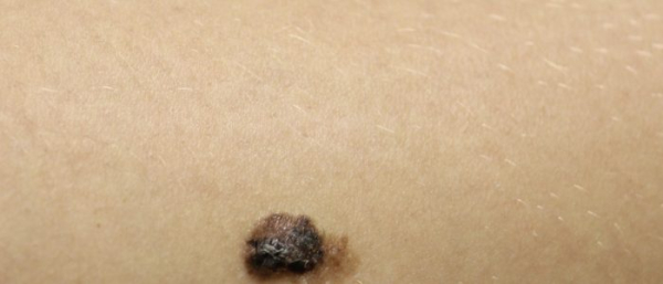 Как быстро развивается меланома?