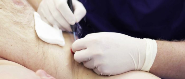 Удаление папиллом электрокоагулятором