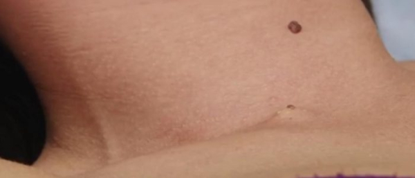 Родинки на шее