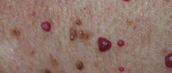 Симптомы и лечение венозной ангиомы