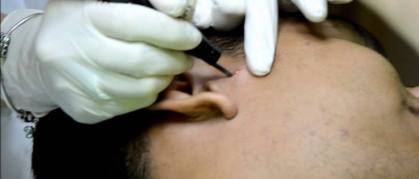 Родинка в белом ореоле