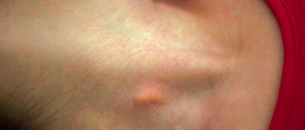 Как избавиться от липомы без операции?