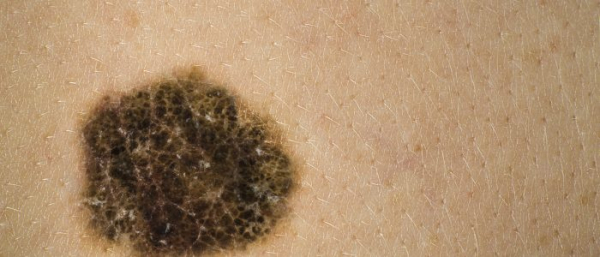 Может ли быть рак от родинки?