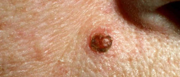 Интрадермальный невус