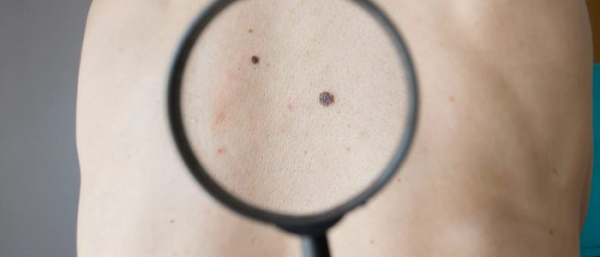 Какие бывают родинки?