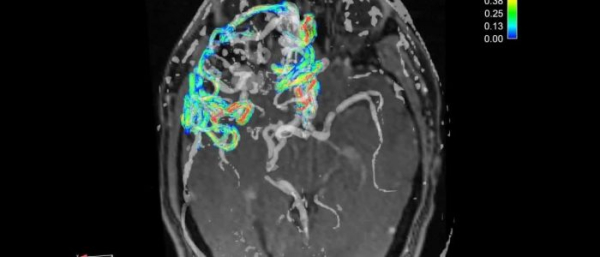 Субдуральная гигрома