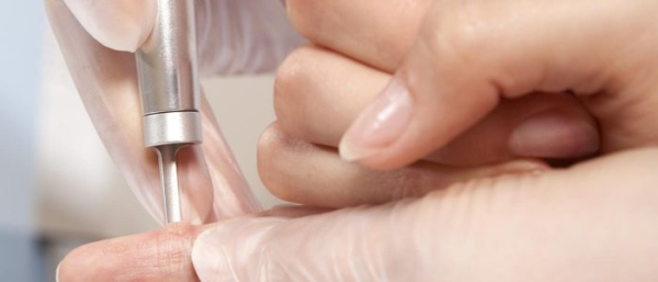 Радиоволновой метод удаления папиллом