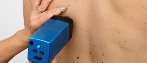 Почему на теле много родинок?