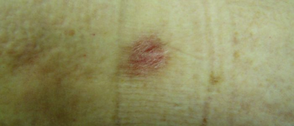 Может ли папиллома перерасти в рак?