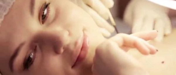 Пограничный пигментный невус