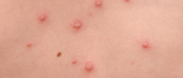 Родинки по телу