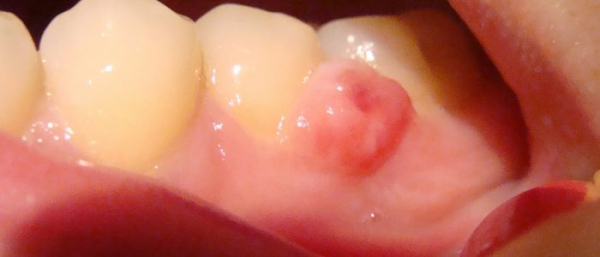 Новообразование ротовой полости