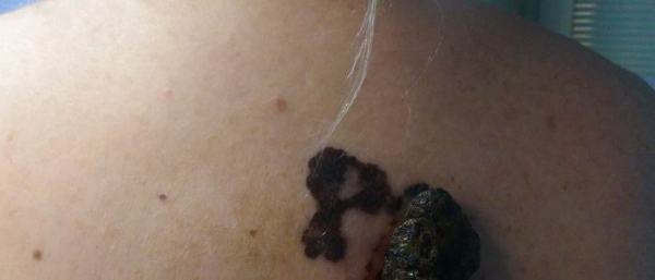 4 стадия меланомы