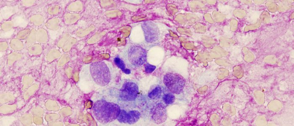 Хондромиксоидные фибромы