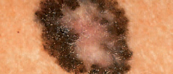 Раковые родинки