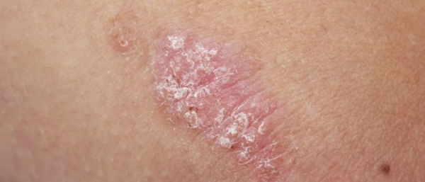 Что делать если загноилась родинка?