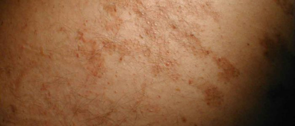 Лечение невуса Беккера