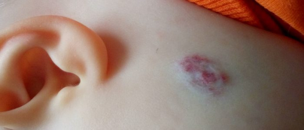 Подкожная гемангиома