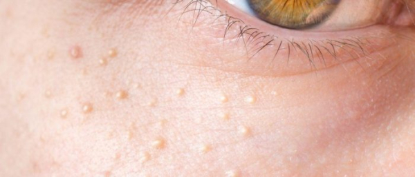 Жировик под глазом