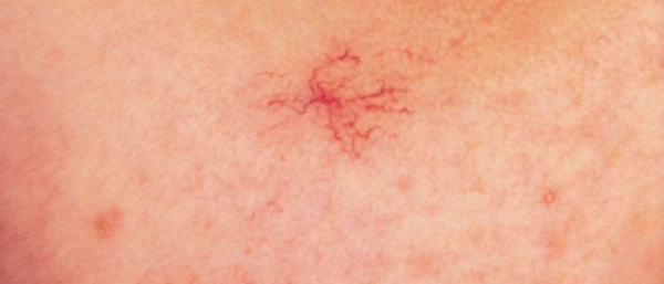 Венозная гемангиома