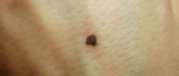 Родинка изменила цвет