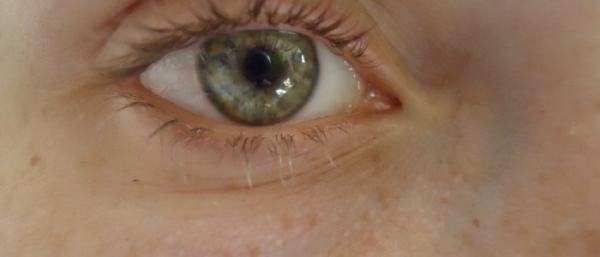 Милиумы на веках