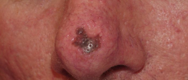 Рецидивы меланомы