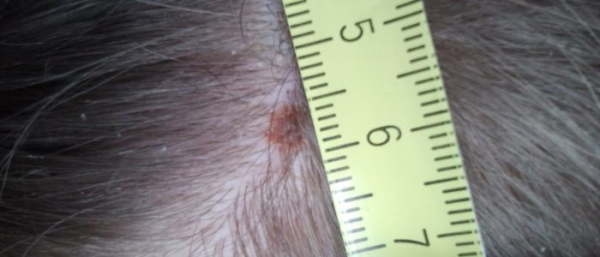 Родинки на голове