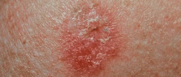 Лечение плоскоклеточного кератоза