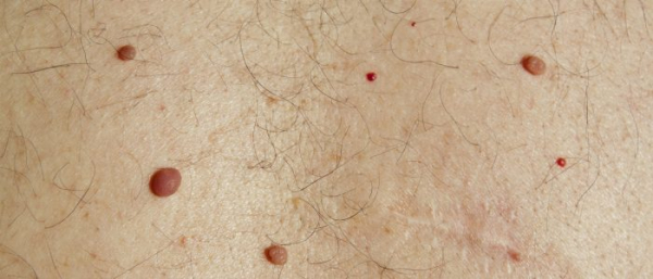 Родинка в паху