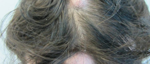 Липома на голове