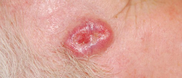 Методы удаления базалиомы