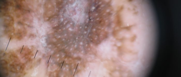 Плоскоклеточные новообразования