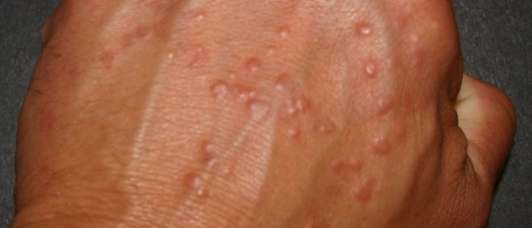 Папилломы чешутся