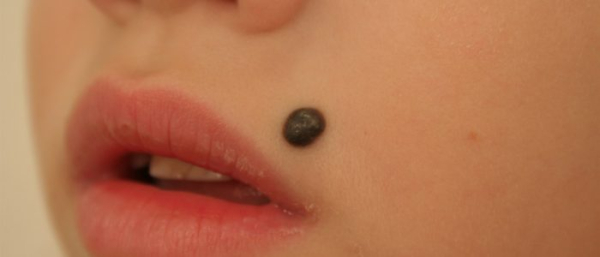 Болят родинки