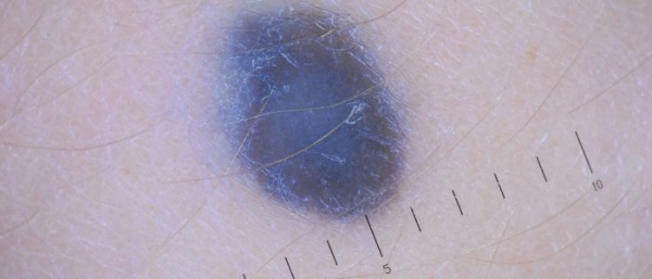 Синий невус